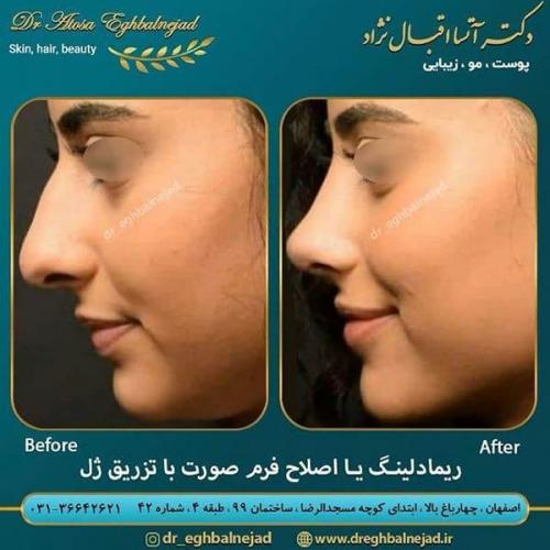 ریمادلینگ-صورت-با-تزریق-ژل