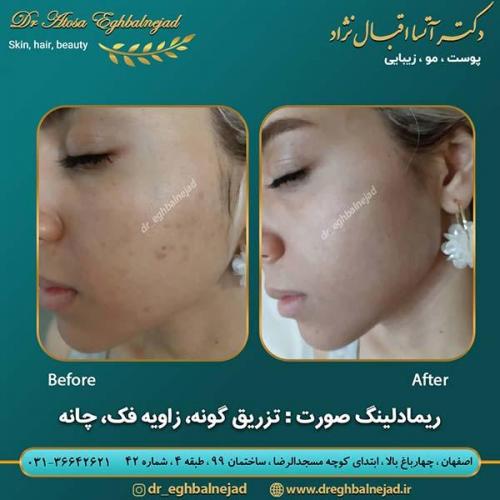 ریمادلینگ-صورت-با-تزریق-گونه-زاویه-فک-و-چانه