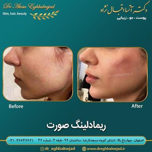 ریمادلینگ-صورت