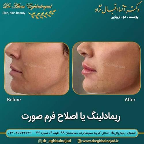 ریمادلینگ-یا-اصلاح-فرم-صورت