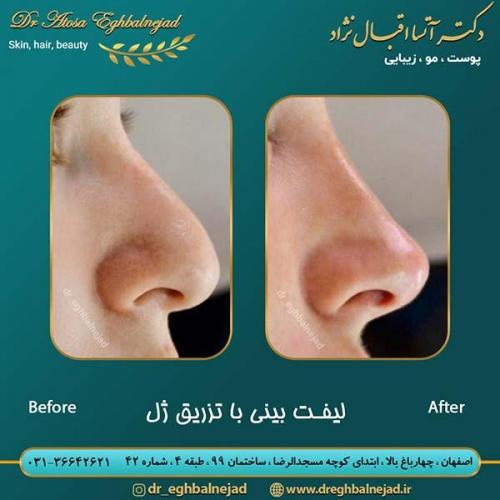 لیفت-بینی-با-تزریق-ژل