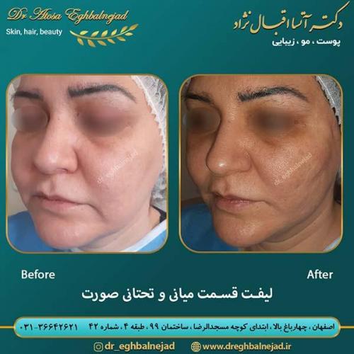 لیفت-قسمت-میانی-و-تحتامی-صورت-1