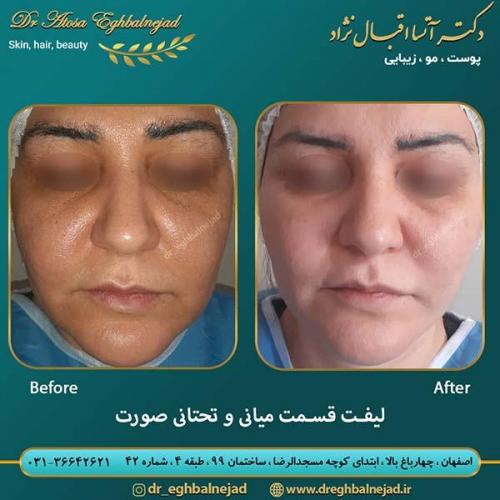 لیفت-قسمت-میانی-و-تحتانی-صورت