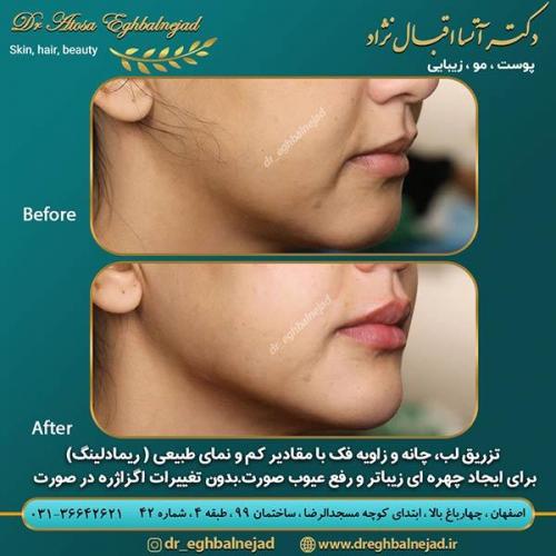 مادلینگ-صورت-1