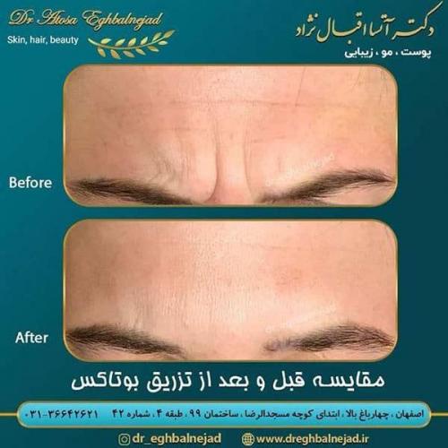 مقایسه-قبل-و-بعد-از-تزریق-بوتاکس