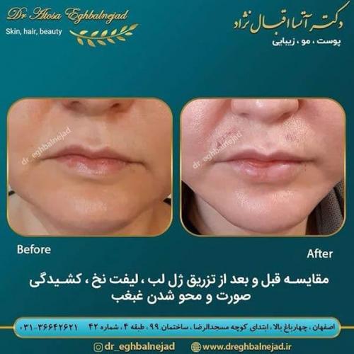 مقایسه-قبل-و-بعد-تزریق-ژل-لب-و-لیفت-نخ