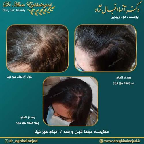 مقایسه-موها-بل-و-بعد-از-هیرفیلر