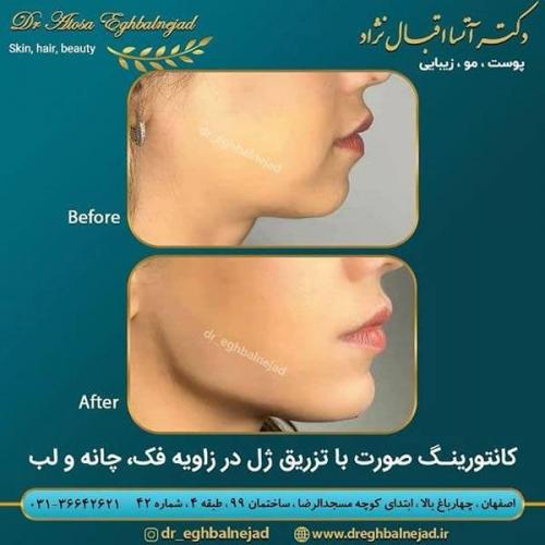 کانتورینگ-صورت-با-تزریق-ژل-در-زاویه-فک-چانه-و-لب