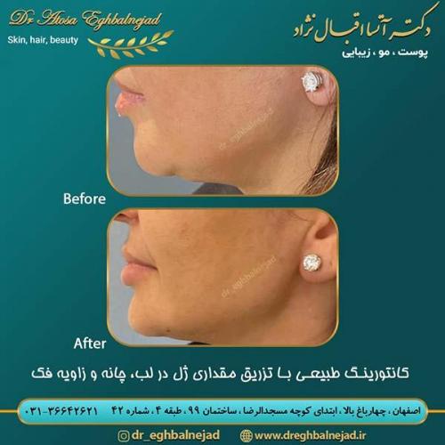 کانتورینگ-صورت-با-مقداری-ژل-در-لب-چانه-و-زاویه-فک