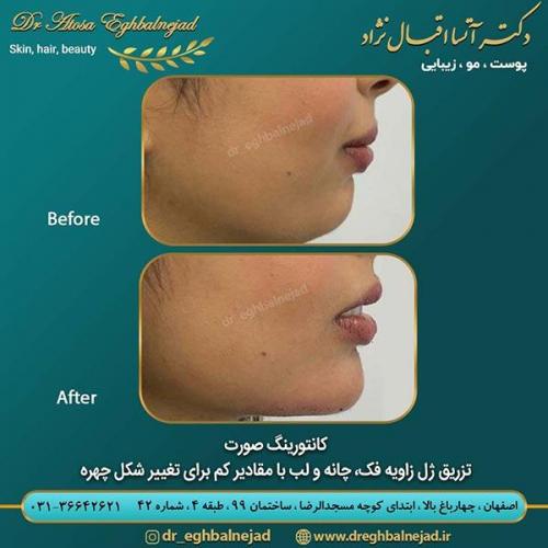 کانتورینگ-صورت-تزریق-ژل-زاویه-فک-و-لب