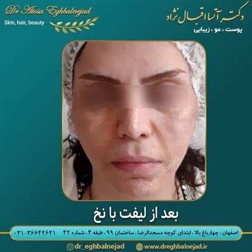بعد-از-لیفت-با-نخ