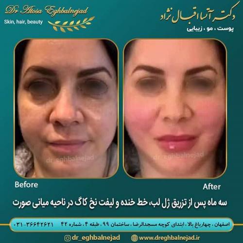 تزریق-ژل-و-لیفت-با-نخ