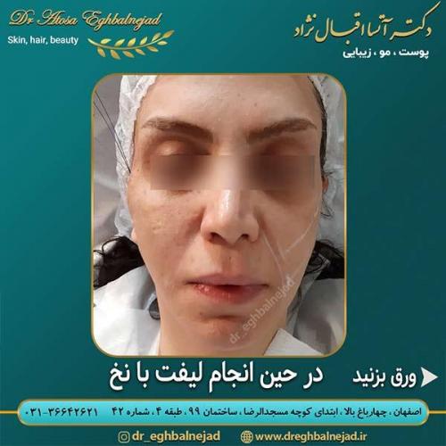 در-حین-انجام-لیفت-با-نخ