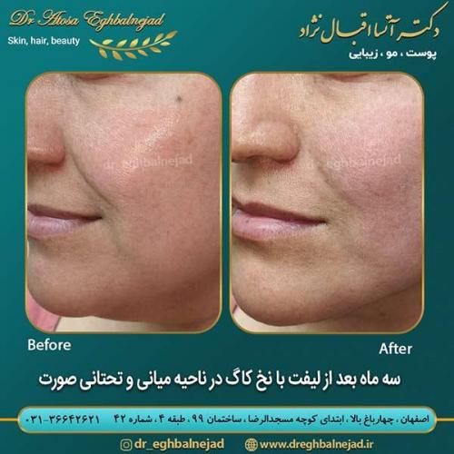 سه-ماه-بعد-از-لیفت-با-نخ
