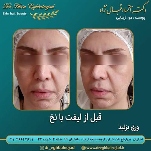 قبل-از-لیفت-با-نخ