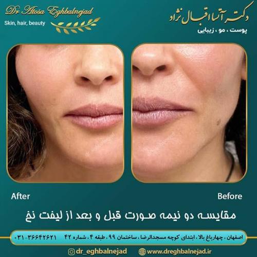 قبل-و-بعد-از-لیفت-با-نخ