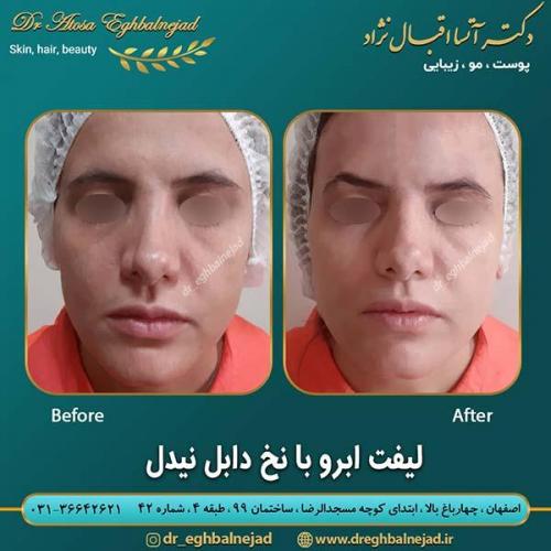 لیفت-ابرو-با-نخ-دابل-نیدل