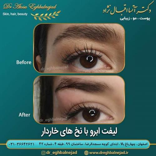 لیفت-ابرو-با-نخ-های-خاردار