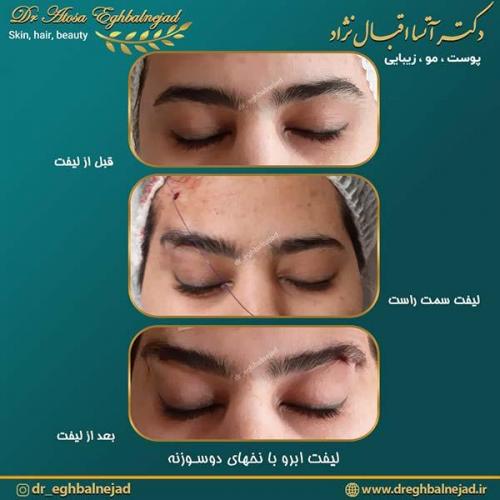لیفت-ابرو-با-نخهای-دوسوزنه