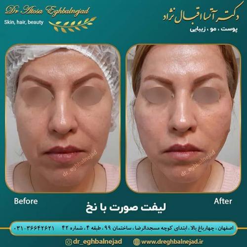 لیفت-با-نخ-1