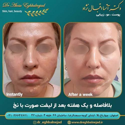 لیفت-با-نخ-2