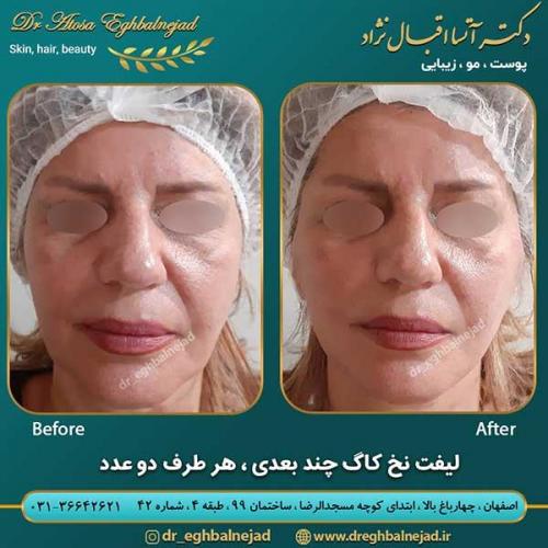 لیفت-با-نخ-3
