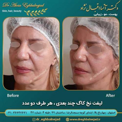 لیفت-با-نخ-4