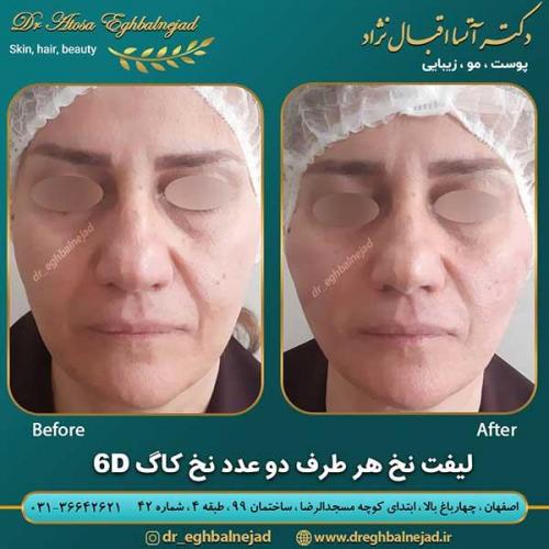 لیفت-با-نخ-5