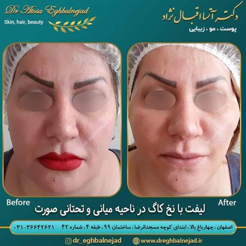 لیفت-با-نخ-کاگ-در-ناحیه-میانی-و-تحتانی-صورت