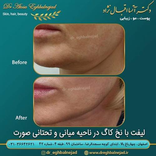 لیفت-با-نخ-کاگ-در-ناحیه-میانی-و-تحتانی-صورت (1)
