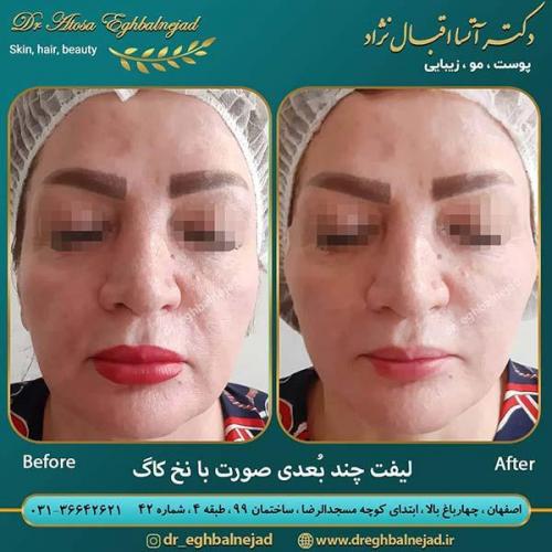 لیفت-با-نخ-کاگ