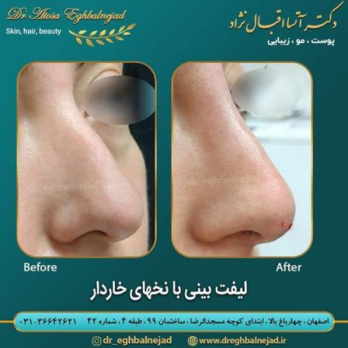 لیفت-بینی-با-نخ-های-خاردار