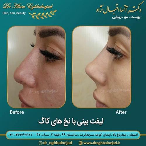 لیفت-بینی-با-نخ-های-کاگ