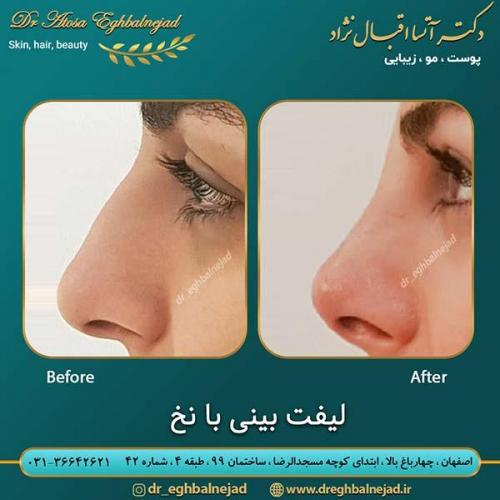لیفت-بینی-با-نخ