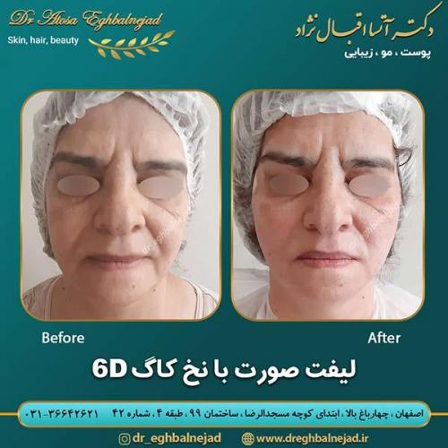 لیفت-صورت-با-نخ-کاگ-7