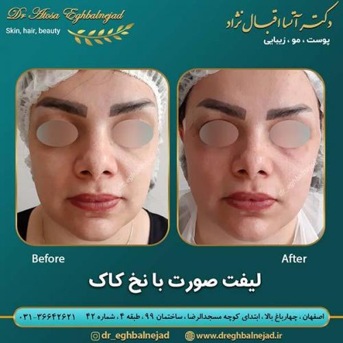 لیفت-صورت-با-نخ-کاگ-8