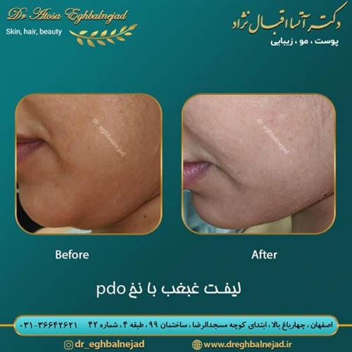 لیفت-غبغب-با-نخ-pdo-10