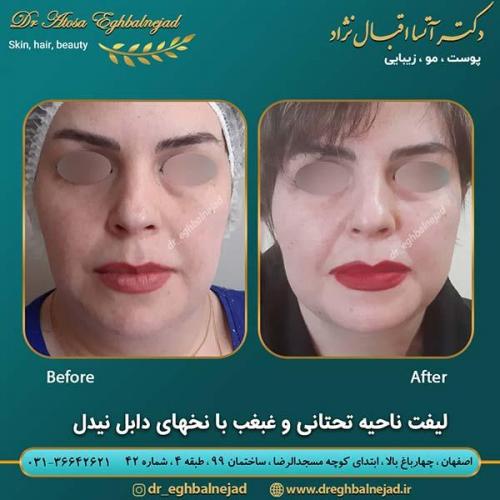 لیفت-غبغب-با-نخ-های-دابل-نیدل-2