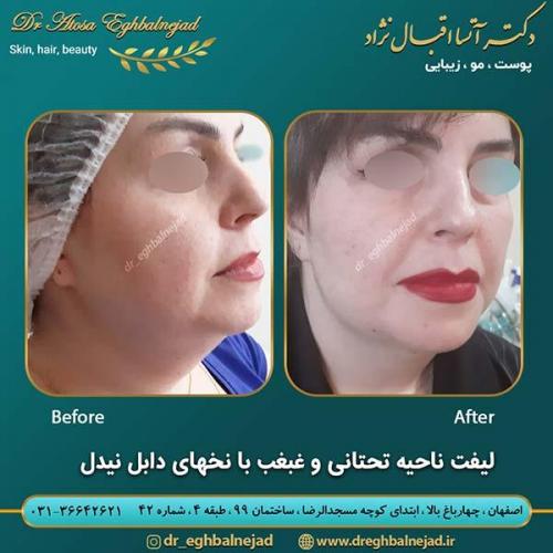 لیفت-غبغب-با-نخ-های-دابل-نیدل