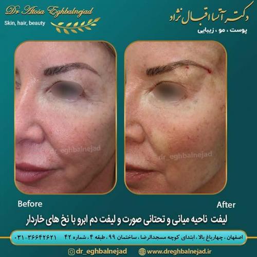 لیفت-ناحیه-میانی-و-تحتانی-صورت-با-نخ-های-خاردار