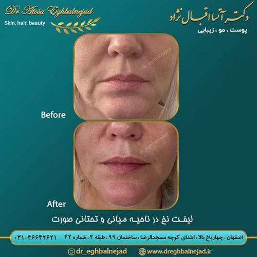 لیفت-نخ-در-ناحیه-میانی-و-تحتانی-صورت