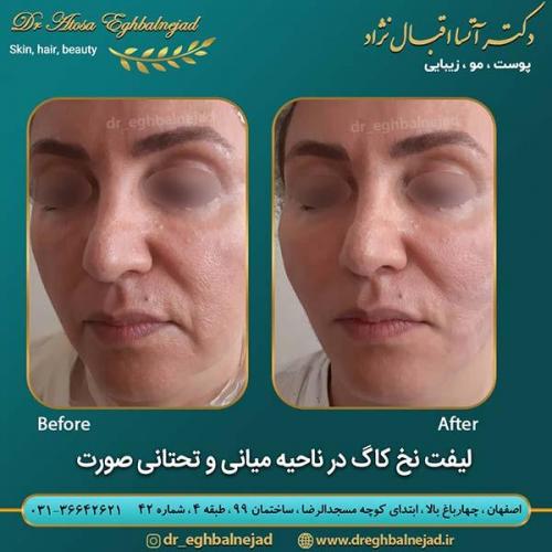 لیفت-نخ-کاگ-در-ناحیه-میانی-و-تحتانی-صورت-1