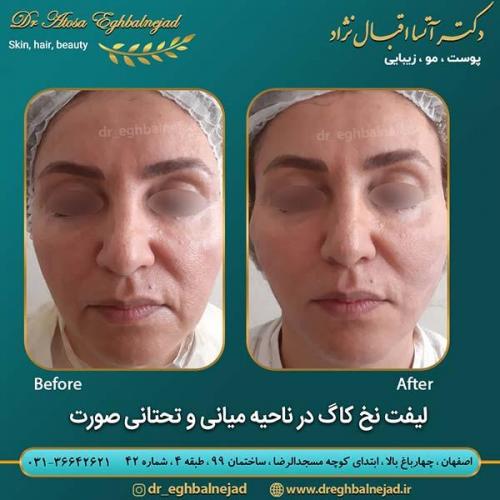 لیفت-نخ-کاگ-در-ناحیه-میانی-و-تحتانی-صورت